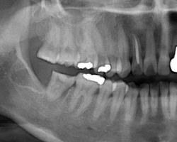 歯牙移植直後X線写真