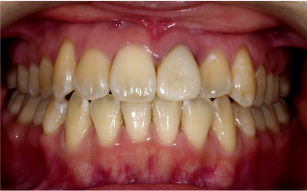 前歯歯列不正症例